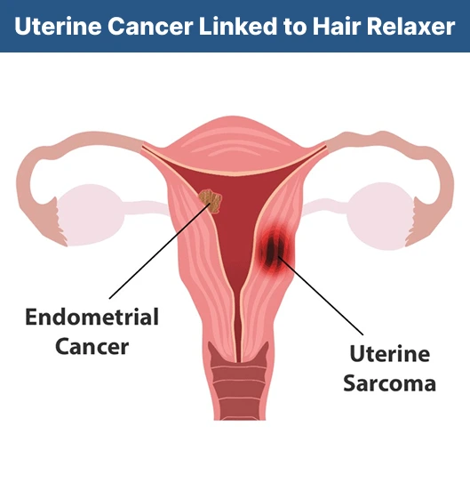 cancer